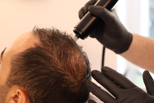 Capelli sottili e senza volume: perché per la nostra redazione il Dottor Cristiano Guerra è il miglior tricologo di Roma quando la chioma perde corpo